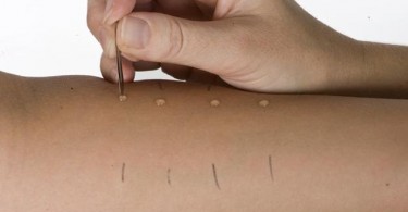skin prick test