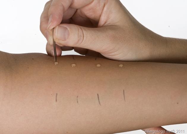 skin prick test