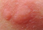 pomfo orticaria