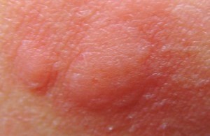 pomfo orticaria