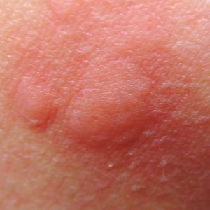 pomfo orticaria