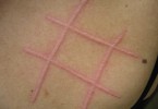 Orticaria - Cause, sintomi e rimedi