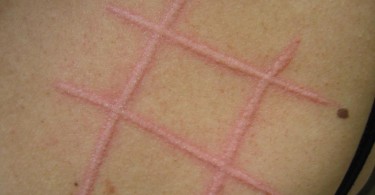 Orticaria - Cause, sintomi e rimedi