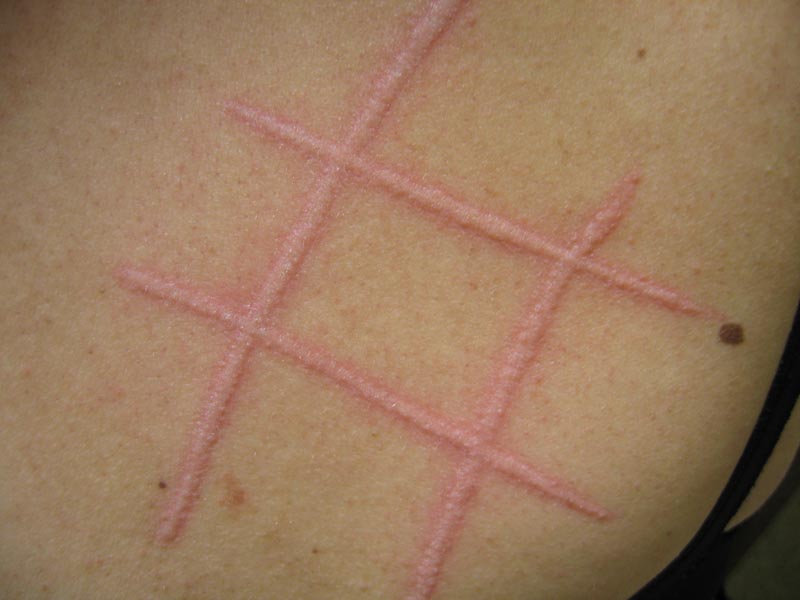 Orticaria - Cause, sintomi e rimedi