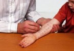 prick test