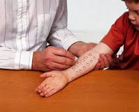 prick test