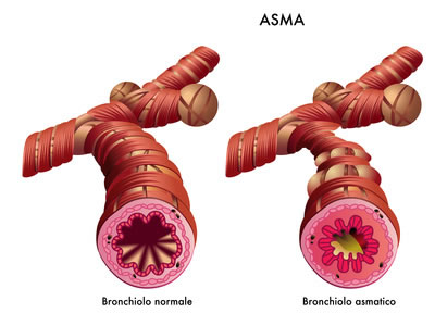 Asma bronchiale - L'immagine raffigura due bronchioli a confronto, quello asmatico e quello normale