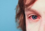 congiuntivite allergica