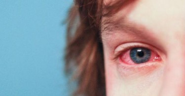 congiuntivite allergica