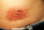 allergia al nichel