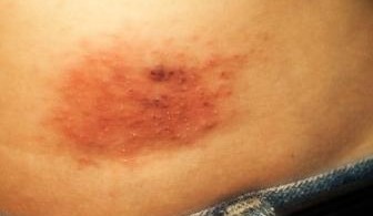 allergia al nichel