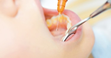 Allergie dal dentista