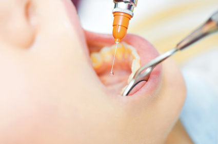 Allergie dal dentista