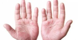 dermatite allergica delle mani