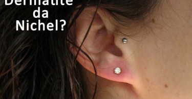 Dermatite da nichel