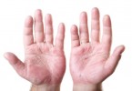 dermatite delle mani