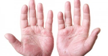 dermatite delle mani