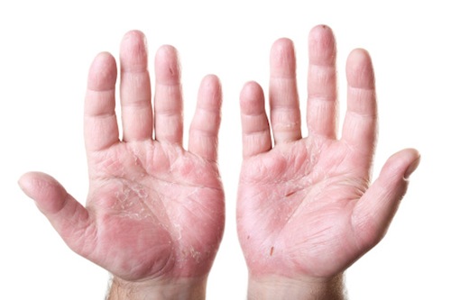dermatite delle mani