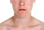 dermatite atopica