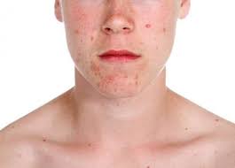 dermatite atopica