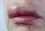 granulomatosi orofacciale