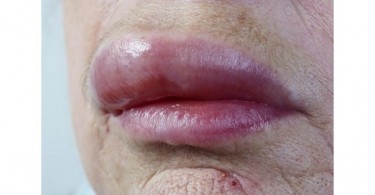 granulomatosi orofacciale