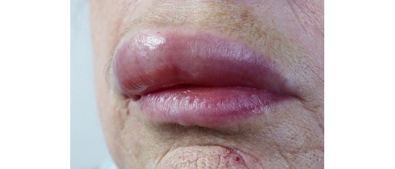 granulomatosi orofacciale